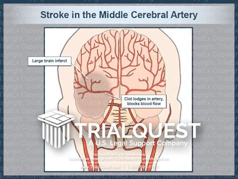 Middle Cerebral Artery Stroke