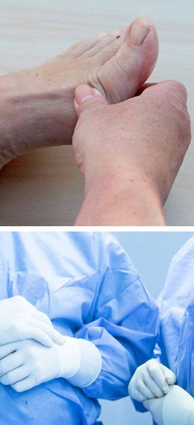 Foot Surgery In West Vancouver | West Vancouver Foot Clinic