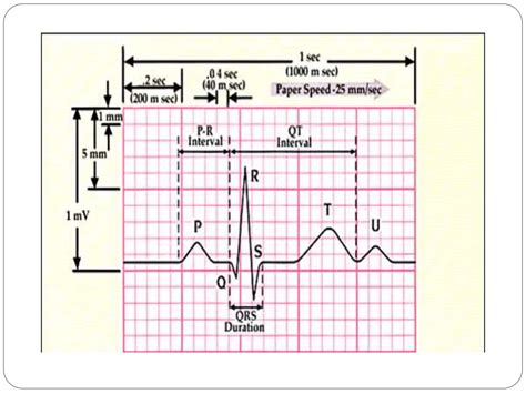 electrocardiogram ecg  ekg learn  sonam pptx
