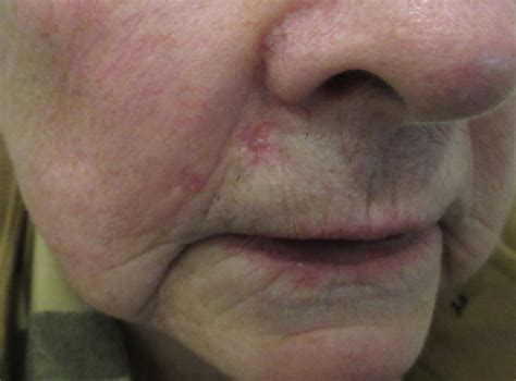 Basal Cell Carcinoma Pictures | Visual BCC Examples by Mr Tehrani