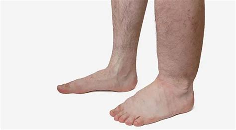 filariasis gejala penyebab  pengobatan halodoc