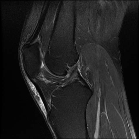 Lobulated Ganglion Cyst Knee Image