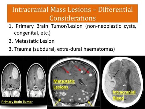 Intracranial Space Occupying Lesions