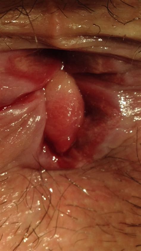 Fissura Anal Aguda E Cr Nica O Que Fazer E N O Fazer Na Experi Ncia Do Proctologista Dr Paulo