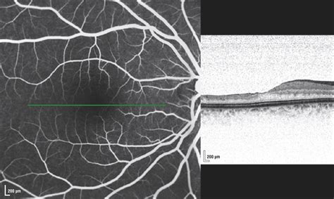 Fundus Fluorescein Angiography And Cross Sectional Spectral Domain Download Scientific Diagram