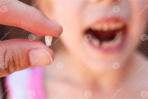 A Criança Perdeu O Dente De Bebê Imagem De Stock Imagem De Cura Dedo