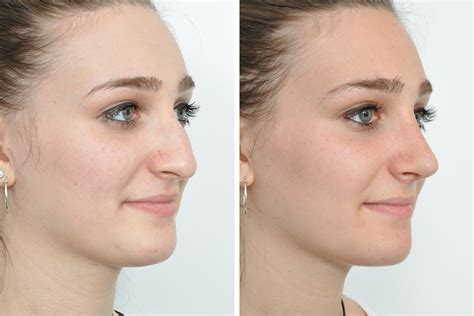 Rhinoplasty Nose Surgery Nose Job For Women In New York City David