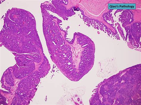 Qiao S Pathology Digital Papillary Carcinoma Microscopic Flickr