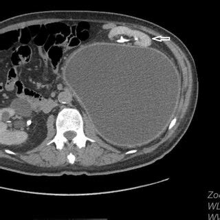 Contrast Enhanced Abdominal Ct Scan Pelvic Section Revealing Dilated