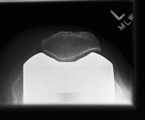 Patella Resurfacing | The Bone School