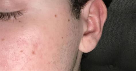 Post Accutane Pie Album On Imgur