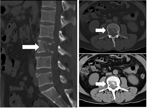 Figure 1 From A Case Report Of Primary Cardiac Angiosarcoma With Dnmt3a