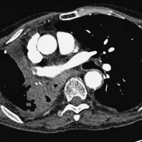 Computed Tomography Pulmonary Angiography Showing A Thrombus In The