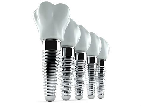 Do Mini Dental Implants Work as Well as Standard Implants?