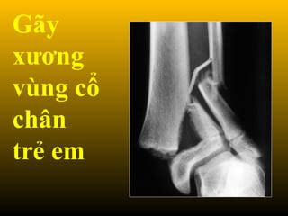 Gay Xg Vung Co Chan Tre Em Ppt