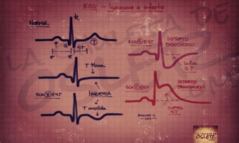 Isquemia Ecg