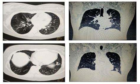 Multi Planner High Resolution Ct Scan Of Chest Showing Fine Fibrotic