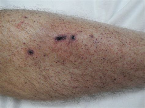 red spots  arms petechiae  tayla hamlyn harris blog