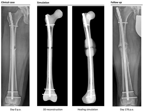 Bone Remodeling Xray
