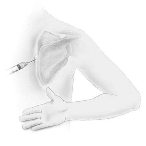 Scapulothoracic Injection At The Medial Border Of The Scapula The Limb