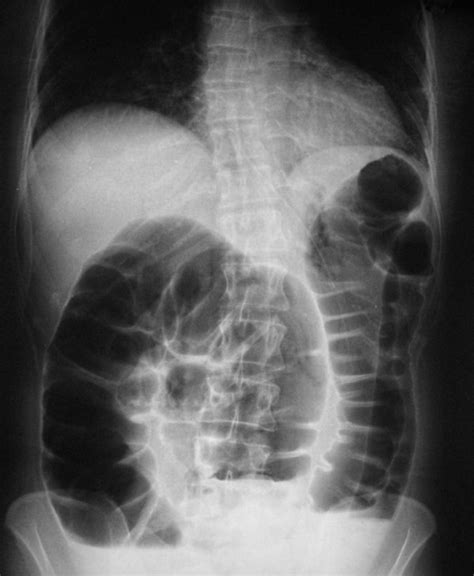 Obstrucción del Intestino Grueso | Concise Medical Knowledge