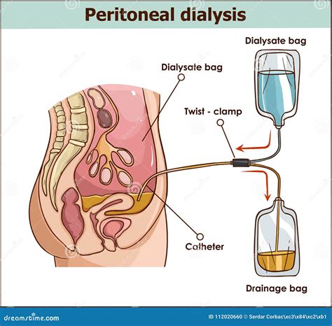 Peritoneal Dialysis are Both Used To Treat Kidney - Vector Illus Stock