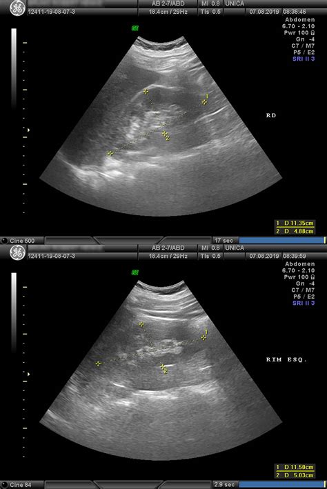 Usg Rins E Vias Urinárias - Ultrassom de Vias Urinárias - Clínica Única