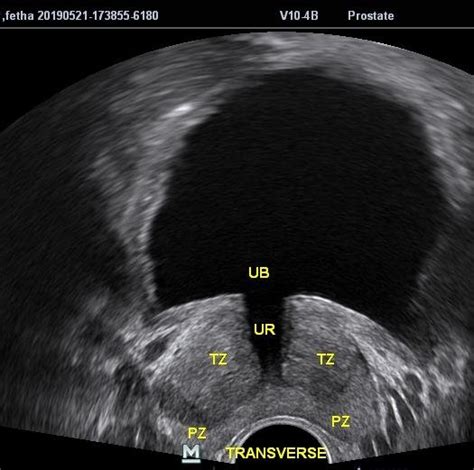 axial  mode ultrasound   prostate showing prostatic zones pz