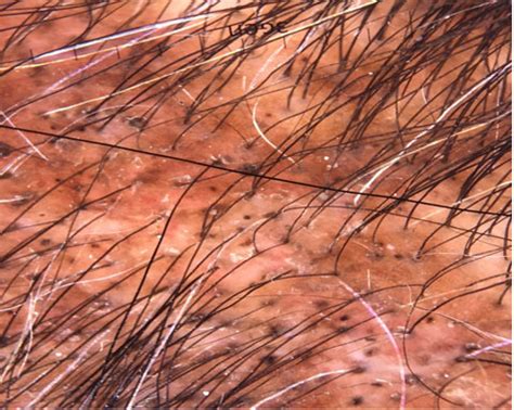 The Role Of Dermoscopy In Assessment Of The Activity And Scarring