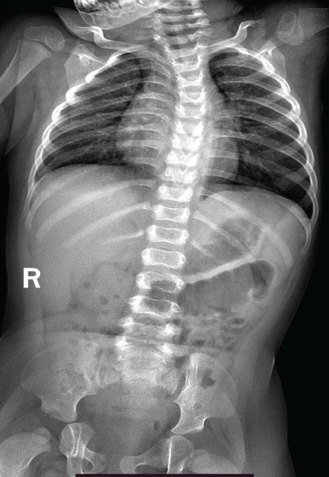 Clinical Images Of The Lrs Patient A Patient Ii The Lrs Probands