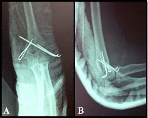 Postoperative Anteroposterior And Lateral X Ray Views Of The Left Elbow