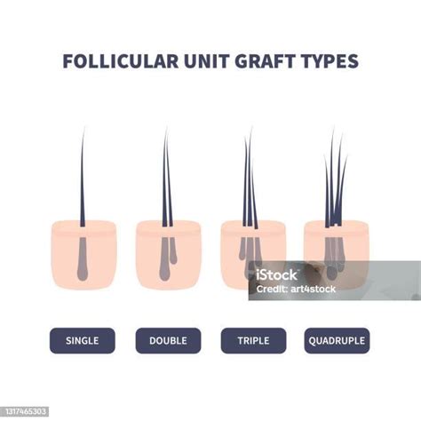 모발 이식용 모발 이식 타입 Hair Transplant에 대한 스톡 벡터 아트 및 기타 이미지 Hair Transplant