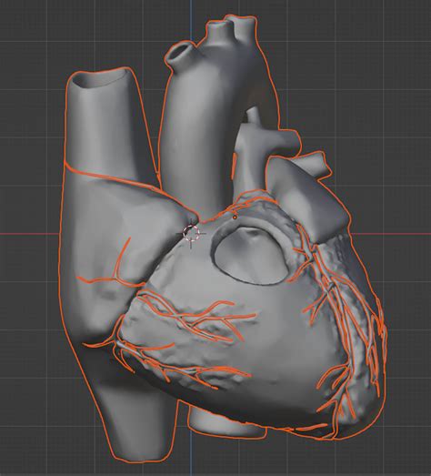 3D Model of Heart With Tetralogy of Fallot (Tof) by azekapeka