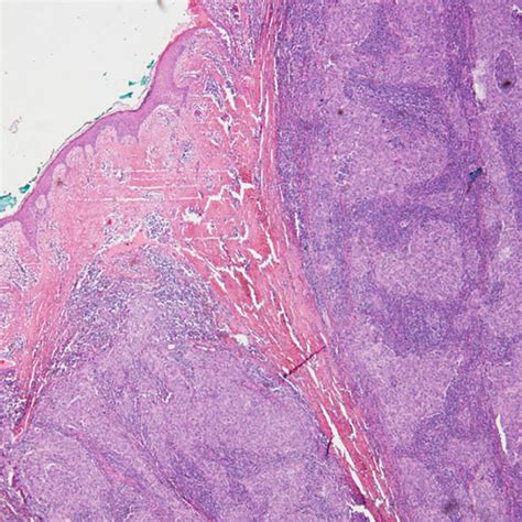 Cervical Lymph Node Metastasis Of Lymphoepithelioma Like Carcinoma Of