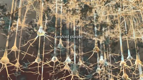 Amyloid Plaques. the Beta-amyloid Protein Involved in Alzheimer`s Disease Stock Illustration ...