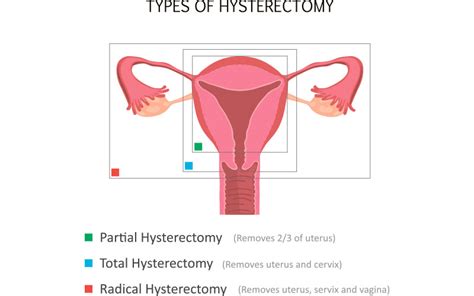 Hormone Replacement Therapy After Hysterectomy