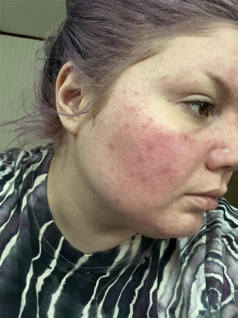 Skin mite flare? : r/Rosacea