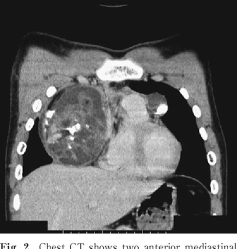 Figure 2 From A Case Of Mediastinal Mixed Germ Cell Tumor Coexisting