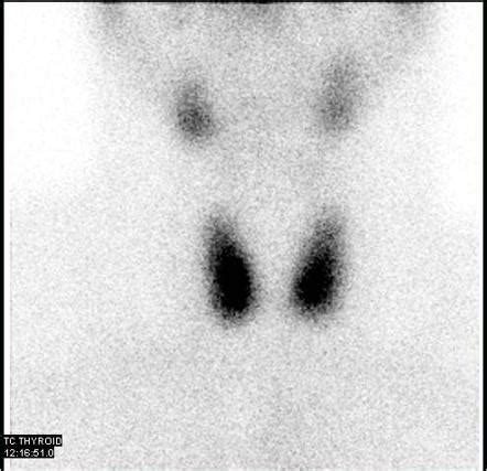 Parathyroid adenoma | Radiology Case | Radiopaedia.org