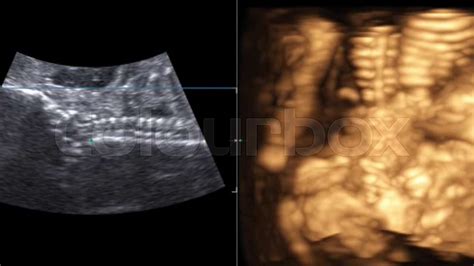 Motion Of D Ultrasound Echography Of Baby Un Mother S Womb Life