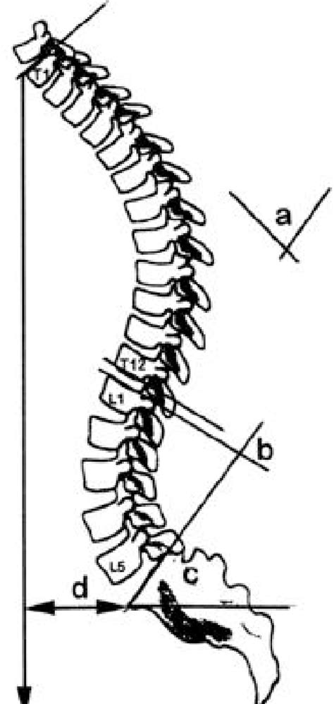 Figure From Clinical Results After Corrective Osteotomy Of The