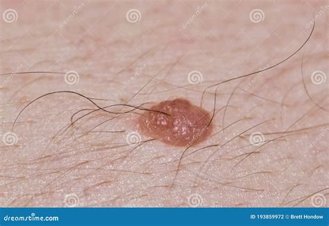 Hairy Mole on Fair Caucasian Skin. Stock Photo - Image of abstract ...