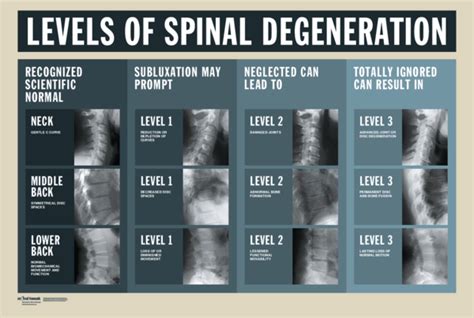 Levels Of Spinal Degeneration Spinal Degeneration Spinal Spine Health