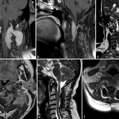 A Coronal And B Sagittal T1 Weighted Images Demonstrating The