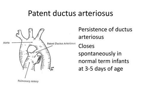 Patent Ductus Arteriosus Ppt