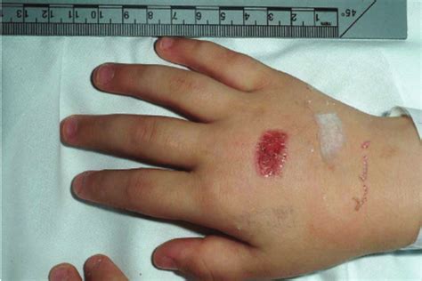 Salbutamol Inhaler Induced Burn Right Hand Download Scientific Diagram