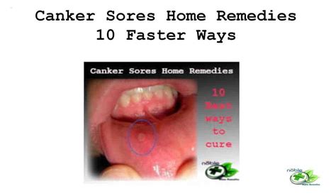 Canker Sores Home Remedies 10 Best Ways to Heal