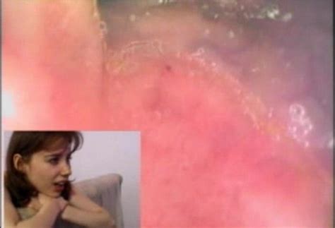 Girls Receive Colonoscopy Before Anal ThisVid