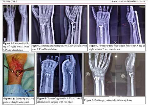 Volar Radiocarpal Subluxation An Unusual Complication Following Distal