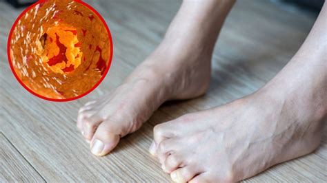 Calambres En Los Pies Podrían Ser Síntoma De Esclerosis Múltiple Salud180